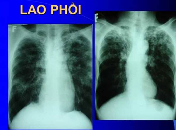 Chụp X-quang phổi nhằm xác định tổn thương nếu bị lao phổi hoặc lao màng phổi phối hợp